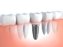 Dental Implants Specialist Bethesda MD