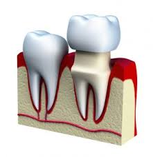 Tooth extraction Near Bethesda MD